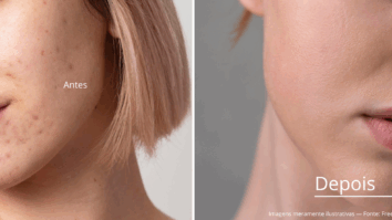 Acne e Espinhas: Estratégias e Tratamentos Comprovados para Cuidar da Sua Pele